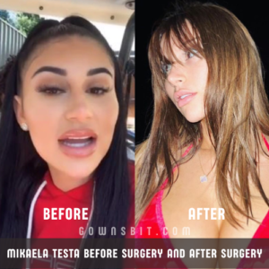 Mikaela Testa before Surgery and After Surgery